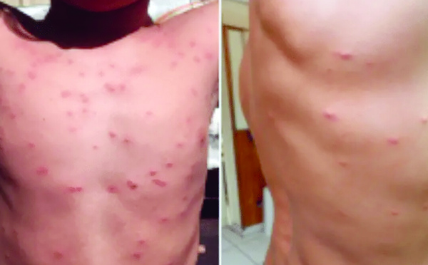 Deux cas de dermatite du surfeur signalés à Papara