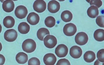 Bientôt des greffes de moelle osseuse sans chimiothérapie, moins dangereuses