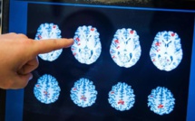 Une commotion cérébrale chez les jeunes peut avoir des effets à long terme (étude)