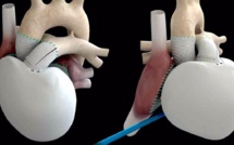 Carmat implante un premier coeur artificiel dans le cadre d'une nouvelle étude