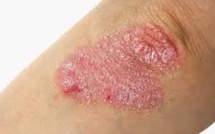 30% des Français ne feraient pas la bise à une personne atteinte de psoriasis