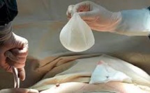 Prothèses mammaires PIP: le certificateur TÜV condamné à verser 60 millions d'euros à des plaignantes