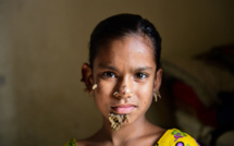 Bangladesh: opération réussie pour la "fille-arbre"