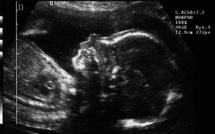 Trisomie: l'AP-HP veut généraliser un test moins risqué que l'amniocentèse