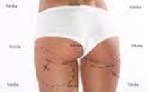 Plus de 1.700 opérations de chirurgie esthétique par jour au Brésil