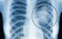Cancer/poumon: mortalité multipliée par 4 en 15 ans chez les femmes de 40 ans