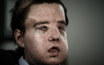 L'homme aux trois visages se dévoile après une nouvelle greffe
