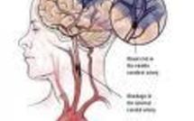 Un marqueur biologique permet de prédire avec fiabilité les cas d'Alzheimer (étude)