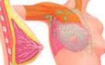 L'ablation préventive des seins réduit dans certains cas le risque de cancer