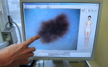 Australie: des chercheurs développent un test sanguin pour détecter le mélanome