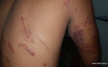 Pirae : mordu par sept chiens errants