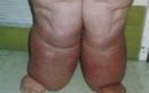 Lutte contre la filariose,  une priorité de santé publique