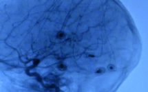 AVC, démence ou Parkinson: 1 femme sur 2 et 1 homme sur 3 à risque