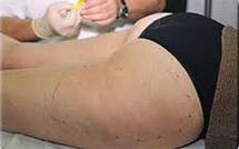 Cellulite: des techniques alternatives à la chirurgie vont être interdites