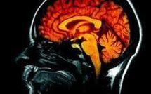 Alzheimer: le cerveau commencerait à se réduire 10 ans avant le diagnostic