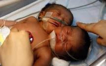 Naissance d'un enfant à deux têtes en Chine