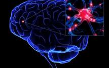Alzheimer : des études pointent une relation avec des traumatismes cérébraux