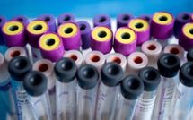 Un test sanguin sur biopuce pourrait révolutionner le dépistage des maladies