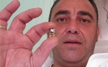 Angers: une dent humaine dans un steak haché