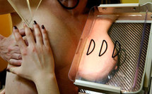 Forte hausse du nombre des cancers du sein au cours des 30 dernières années