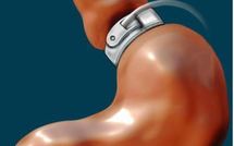Réduction de l'estomac: moins d'accidents cardio-vasculaires et de mortalité