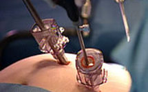 Mieux comprendre le diabète à partir de la chirurgie de l'obésité