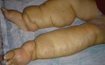 Lutte contre la filariose: lancement de la campagne POD à Pirae