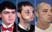 Greffe spectaculaire du visage aux Etats-Unis, la plus étendue à ce jour
