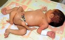 Les médecins pakistanais opèrent avec succès un bébé né avec six jambes