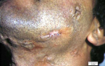 Recrudescence des cas de tuberculose à Madagascar