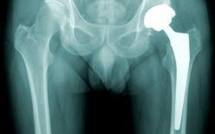 Le médecin n'est pas responsable de la qualité de la prothèse