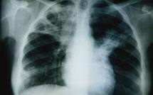 La tuberculose continue à reculer mais le combat reste "fragile"