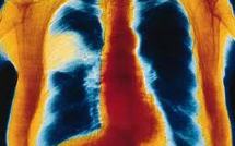 Un enfant meurt des suites d'une pneumonie toutes les 25 secondes dans le monde