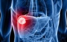 Vers des traitements de plus en plus ciblés grâce aux progrès de la génétique