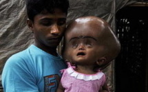 Inde : une petite fille au crâne hypertrophié suscite un élan de solidarité