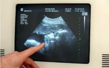 Le Comité d'éthique favorable au dépistage génétique de la trisomie 21