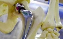 Après les implants mammaires PIP, des prothèses de hanche sur la sellette