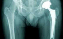 Aucune prothèse défectueuse n'a été posée sur des patients, affirme le fabricant Ceraver
