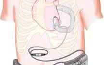 L'Agence du médicament retire certains dispositifs d'assistance cardiaque