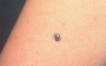 De nouvelles avancées contre le mélanome, un cancer agressif de la peau