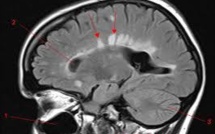 Une thérapie expérimentale prometteuse contre la sclérose en plaques