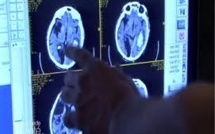 La rééducation, un processus long en cas d'AVC ayant entraîné des déficits