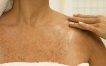 Mélanome avancé : une survie pouvant atteindre dix ans grâce à l'ipilimumab