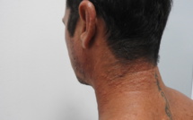 ​La dermatite du surfeur touche la côte ouest