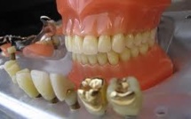 Les écologistes veulent une loi pour bannir le mercure dentaire