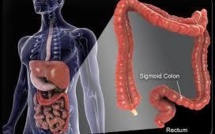 Cancer colorectal: les gastro-entérologues réclament le nouveau test de dépistage