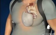 Décès du malade ayant bénéficié de la première implantation d'un coeur artificiel Carmat