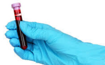 Un test sanguin pour détecter le risque d'apparition d'un Alzheimer dans les trois ans