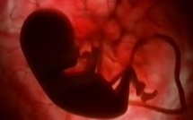 L'autisme résulterait d'anomalies dans la formation cérébrale du foetus