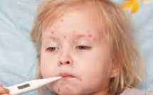 Une nouvelle molécule expérimentale prometteuse contre la rougeole